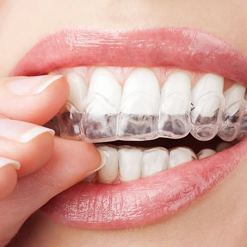 Custom Fitted Mouthguards at Polished Smiles