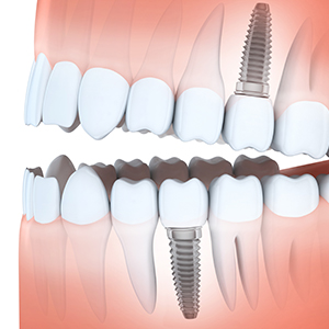 Dental Implants