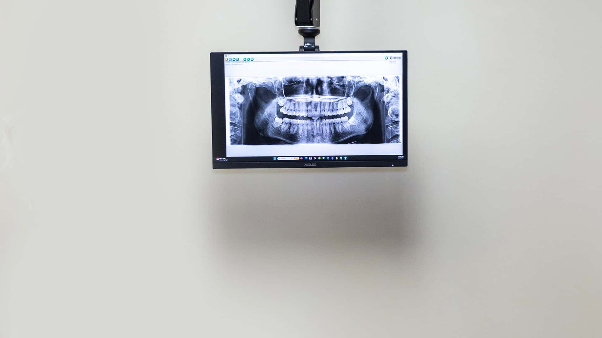 Patient X-Ray Before Dental Fillings