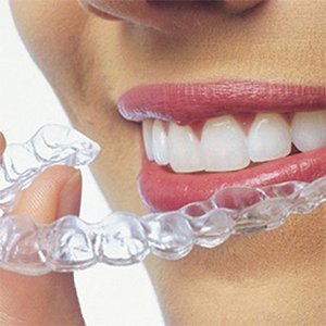 Invisalign Braces