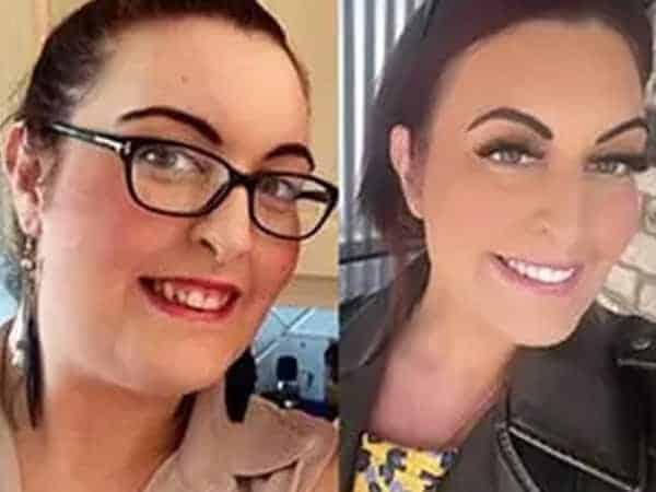 Woman Before and After Invisalign