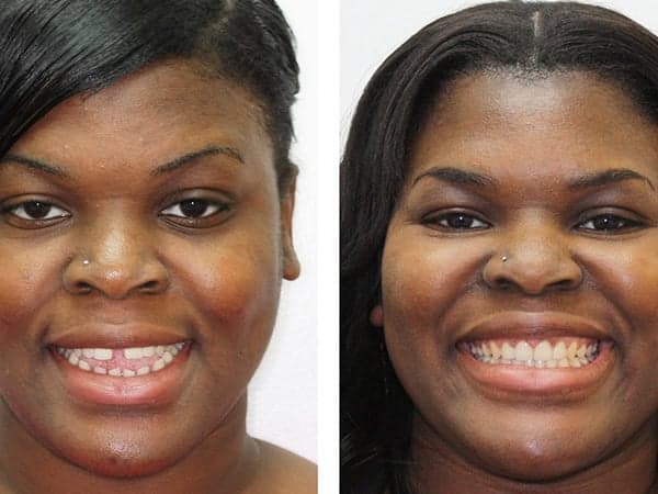 Woman Before and After Invisalign