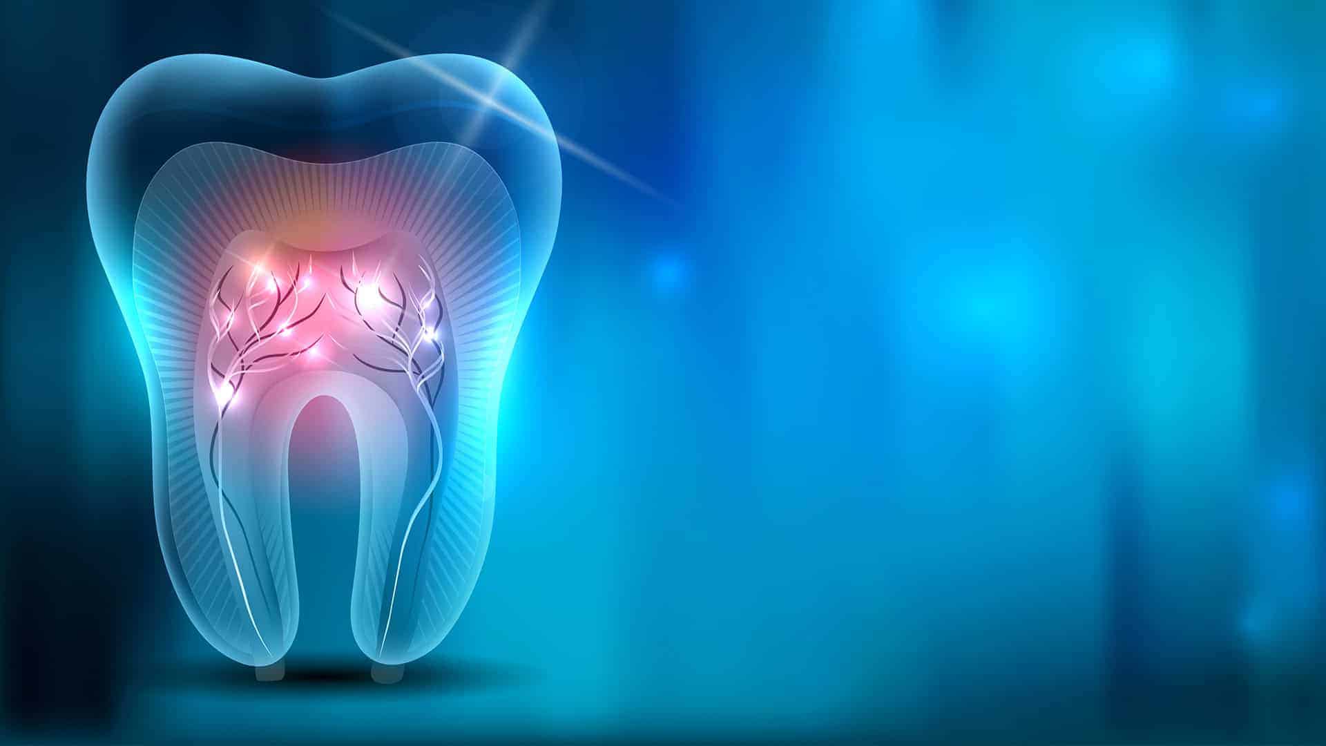 Root Canal X-Ray