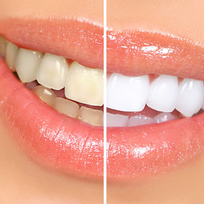 Zoom Teeth Whitening