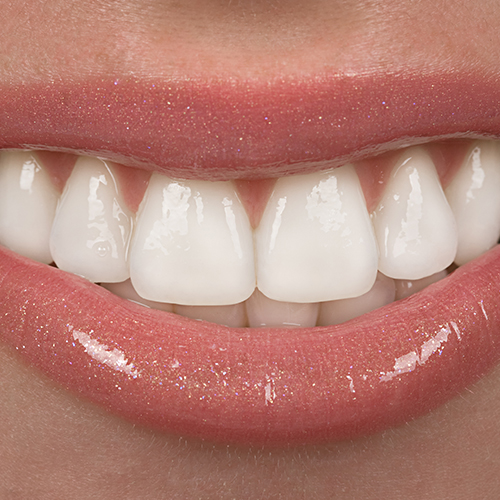 Dental Veneers