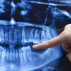 Dental X-Rays